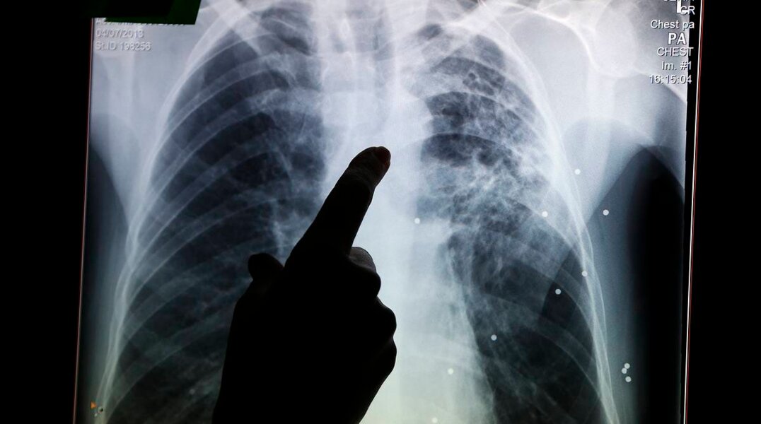 В Пермском крае двоих людей, болеющих туберкулезом, приставы принудительно отправили в больницы