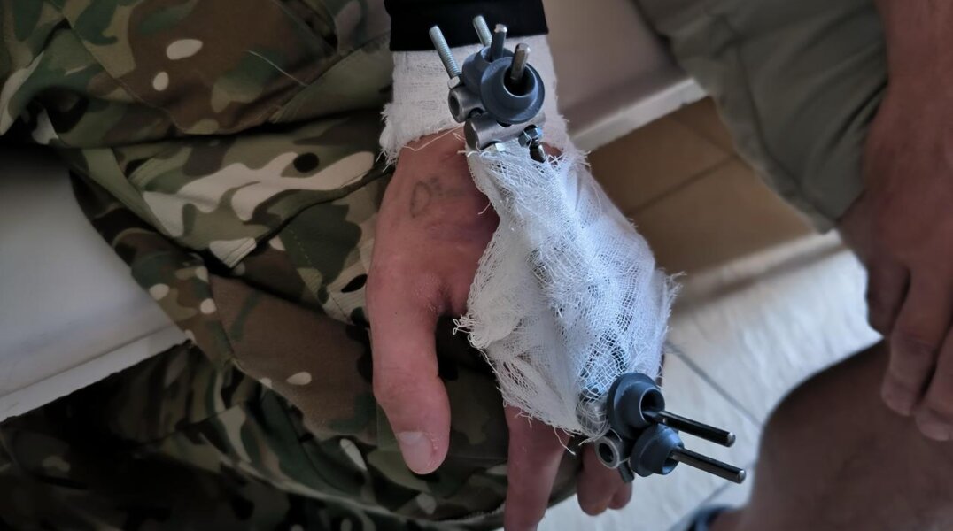 Пермские травматологи разработали аппараты для восстановления кистей рук