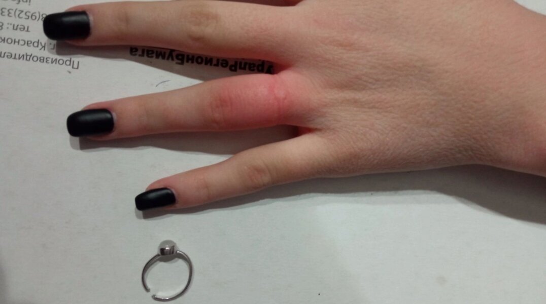 После застолья 16-летней пермячке понадобились спасатели, чтобы снять кольцо