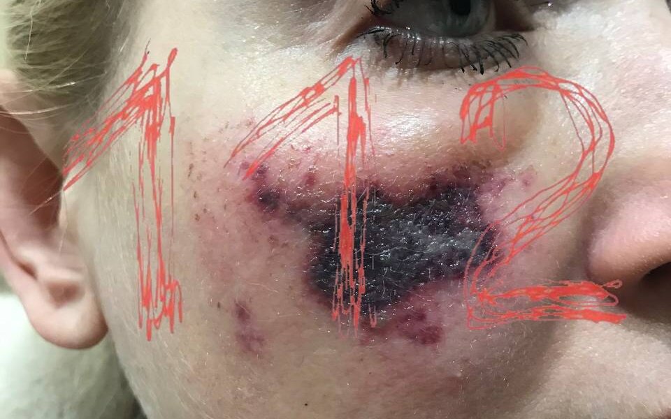 Петербурженка получила некроз кожи лица после похода к косметологу